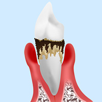 歯を失う原因の第一位～歯周病～
